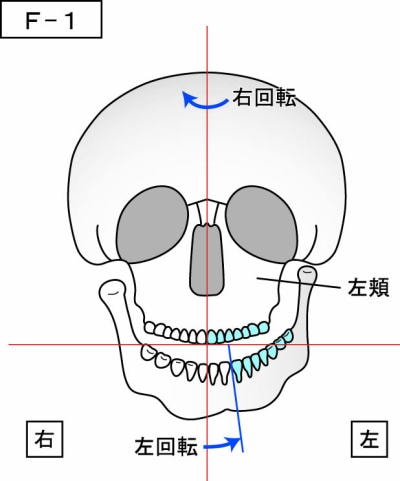 耳詰まりの説明（沖縄県 那覇市 整体・マッサージ 整体院 新しい整体院）